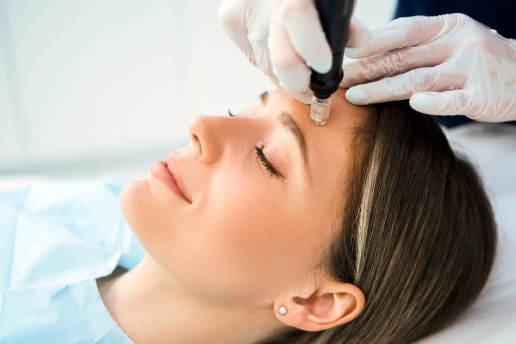Woman getting microneedling treatment