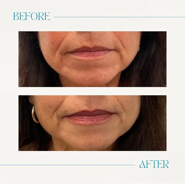 Before and After Lip Fillers Patient